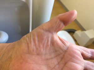 親指の腱鞘炎治療後